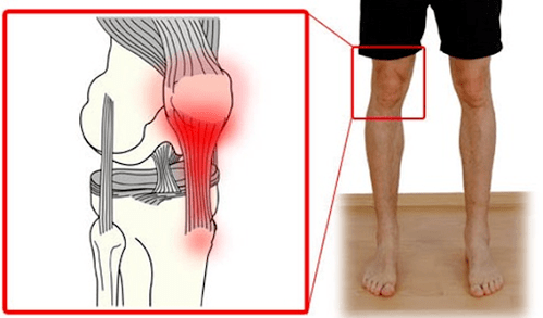 Η τενοντίτιδα είναι φλεγμονή του τενοντιακού ιστού που προκαλεί πόνο στην άρθρωση του γόνατος. 