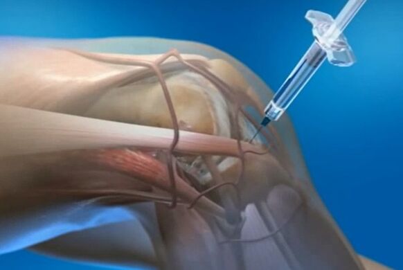 ενδοαρθρικές ενέσεις για οστεοαρθρίτιδα της άρθρωσης του γόνατος