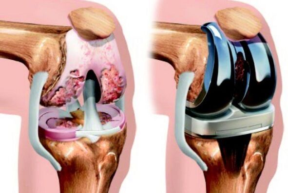 πριν και μετά την οστεοαρθρίτιδα της άρθρωσης του γόνατος στην οστεοαρθρίτιδα